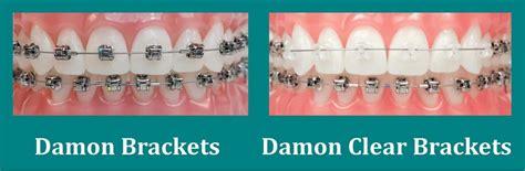 damon brackets vs metal braces|damon clear vs ceramic braces.